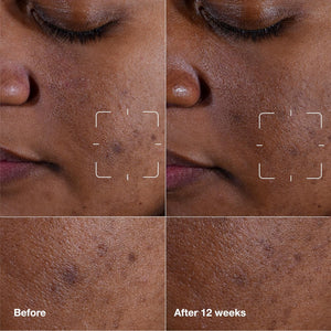 Clinique Clinique Even Better Clinical Dark Spot Clearing Vitamin C Face Serum For All Skin Types | Brightening + Soothing | The Best  India